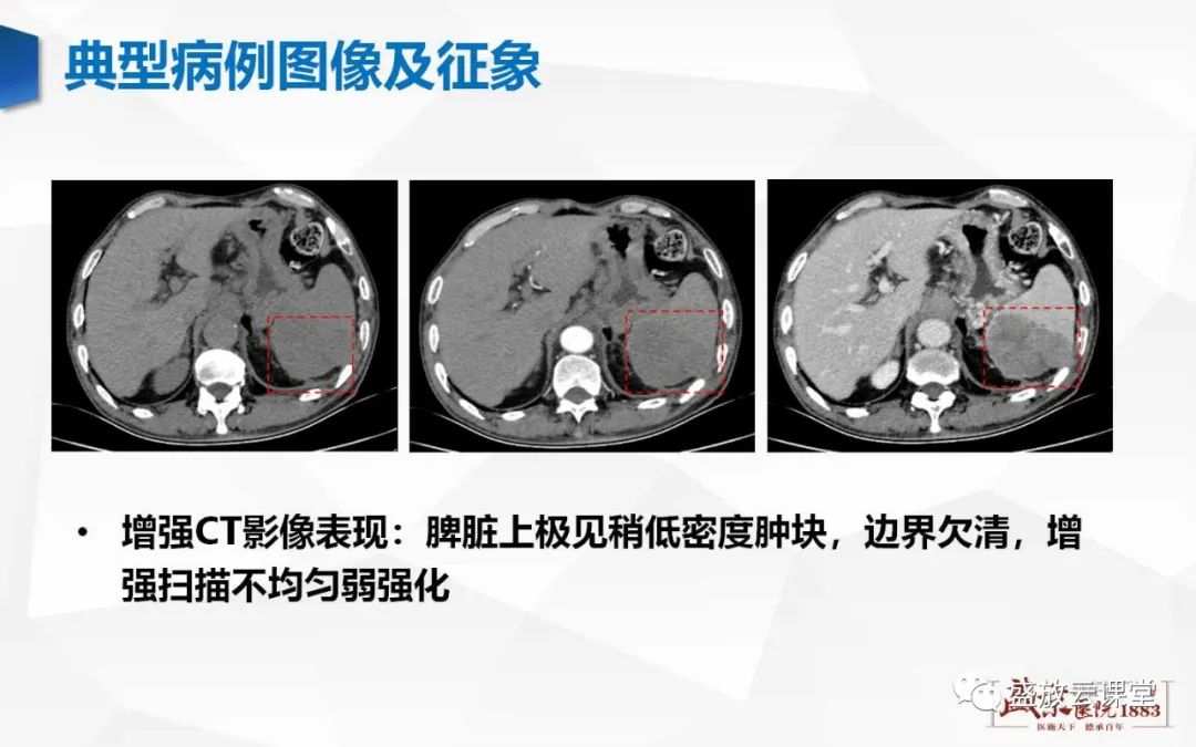 影像PPT - 【病例】脾脏淋巴瘤1例CT影像鉴别诊断-24 影像PPT - 【病例】脾脏淋巴瘤1例CT影像鉴别诊断-24