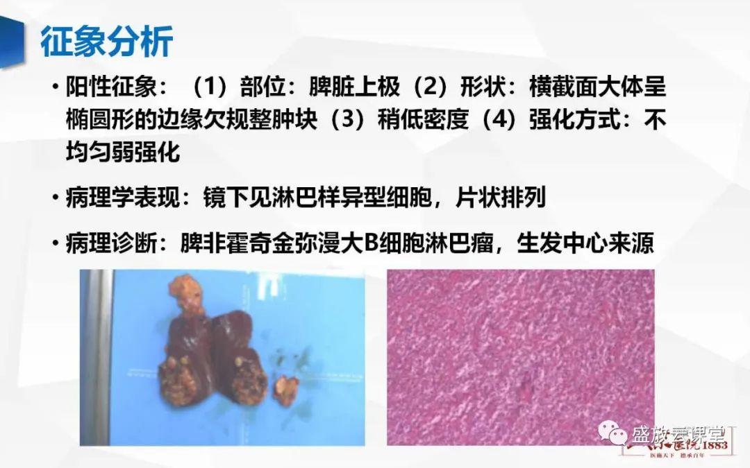 影像PPT - 【病例】脾脏淋巴瘤1例CT影像鉴别诊断-25 影像PPT - 【病例】脾脏淋巴瘤1例CT影像鉴别诊断-25