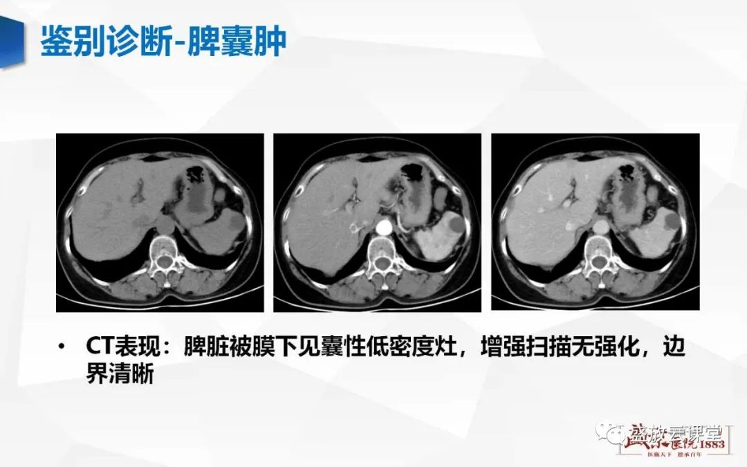 影像PPT - 【病例】脾脏淋巴瘤1例CT影像鉴别诊断-28 影像PPT - 【病例】脾脏淋巴瘤1例CT影像鉴别诊断-28