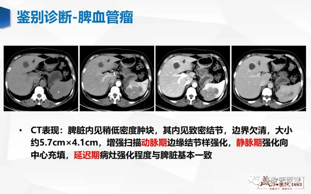 影像PPT - 【病例】脾脏淋巴瘤1例CT影像鉴别诊断-30 影像PPT - 【病例】脾脏淋巴瘤1例CT影像鉴别诊断-30