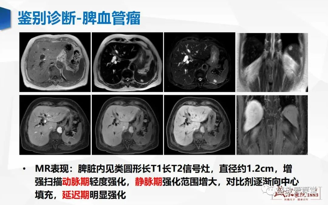 影像PPT - 【病例】脾脏淋巴瘤1例CT影像鉴别诊断-31 影像PPT - 【病例】脾脏淋巴瘤1例CT影像鉴别诊断-31