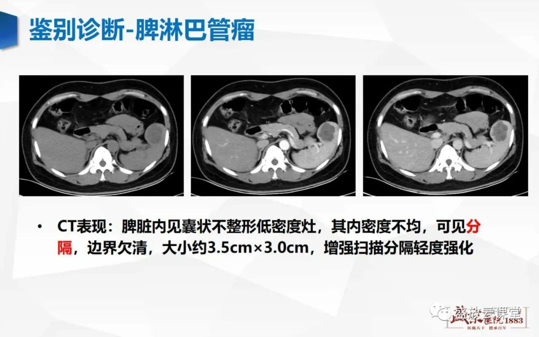 影像PPT - 【病例】脾脏淋巴瘤1例CT影像鉴别诊断-33 影像PPT - 【病例】脾脏淋巴瘤1例CT影像鉴别诊断-33