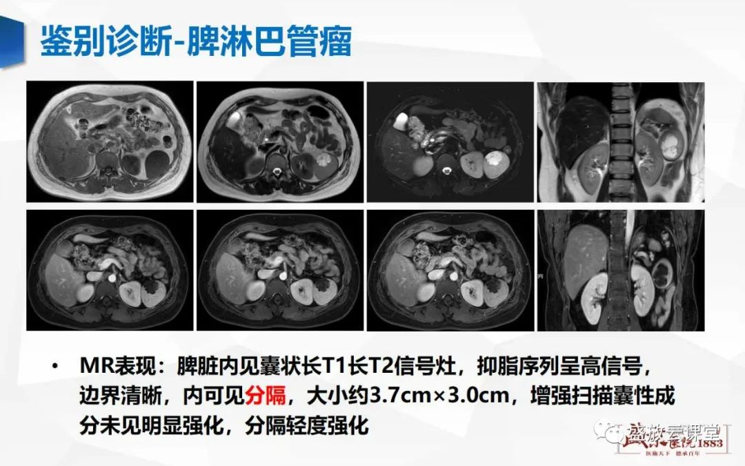 影像PPT - 【病例】脾脏淋巴瘤1例CT影像鉴别诊断-34 影像PPT - 【病例】脾脏淋巴瘤1例CT影像鉴别诊断-34