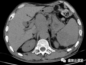 影像PPT - 【病例】脾脏淋巴瘤1例CT影像鉴别诊断-1 影像PPT - 【病例】脾脏淋巴瘤1例CT影像鉴别诊断-1