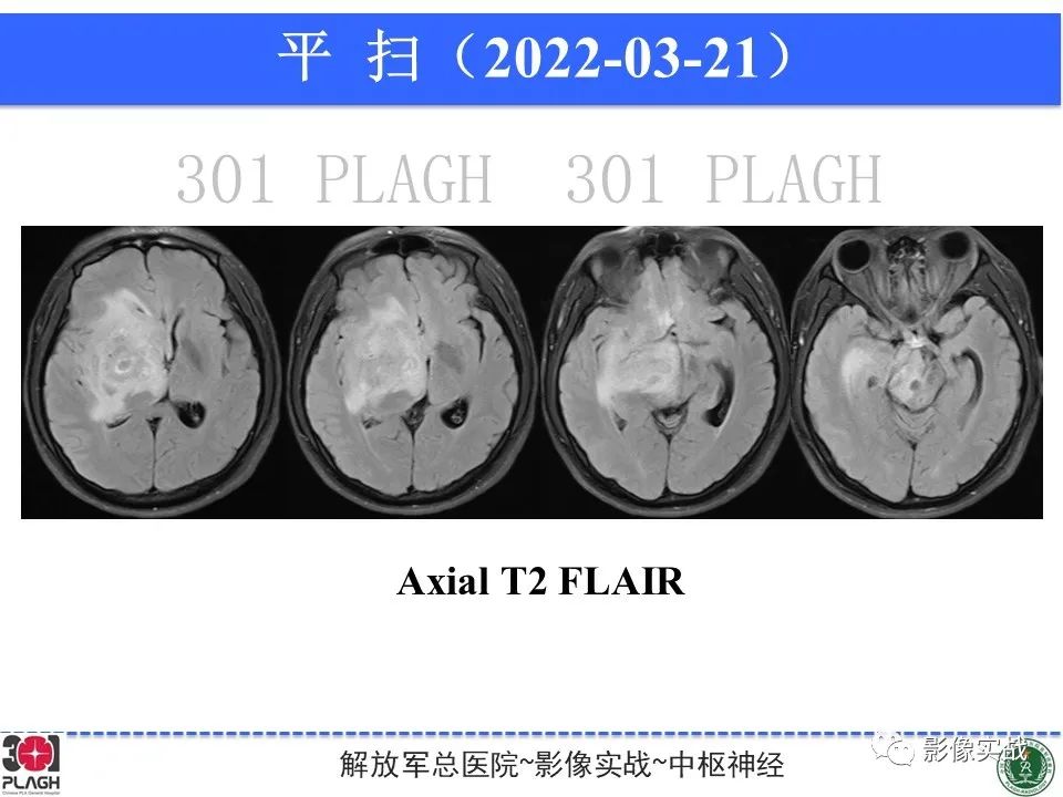 影像PPT - 【病例】中枢神经系统淋巴瘤1例CT及MR影像-10