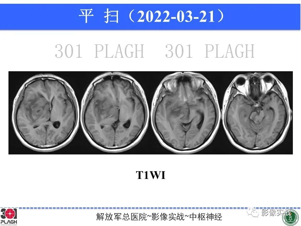 影像PPT - 【病例】中枢神经系统淋巴瘤1例CT及MR影像-6