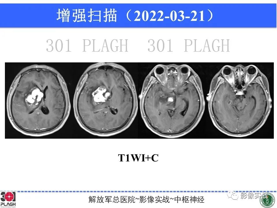 影像PPT - 【病例】中枢神经系统淋巴瘤1例CT及MR影像-11