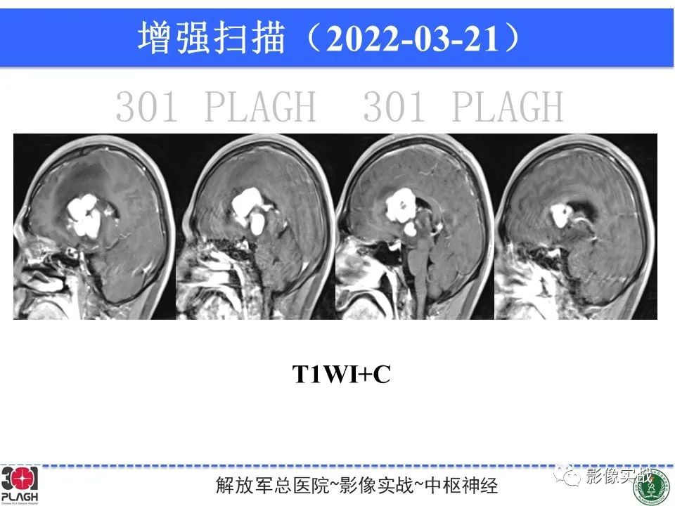 影像PPT - 【病例】中枢神经系统淋巴瘤1例CT及MR影像-13