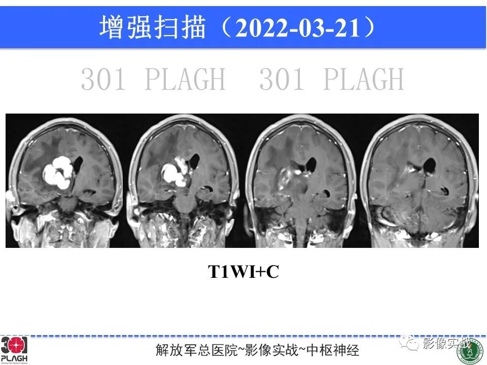 影像PPT - 【病例】中枢神经系统淋巴瘤1例CT及MR影像-12