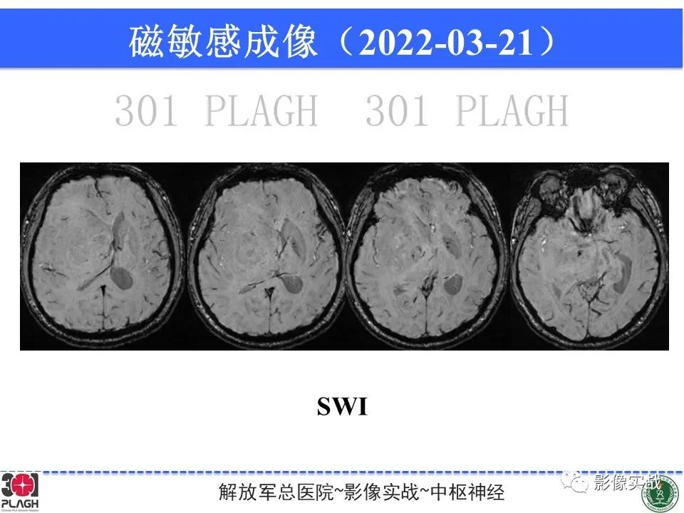 影像PPT - 【病例】中枢神经系统淋巴瘤1例CT及MR影像-14
