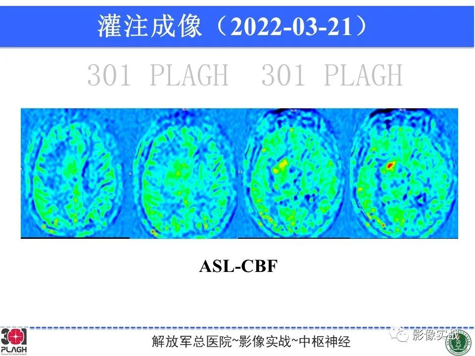 影像PPT - 【病例】中枢神经系统淋巴瘤1例CT及MR影像-15