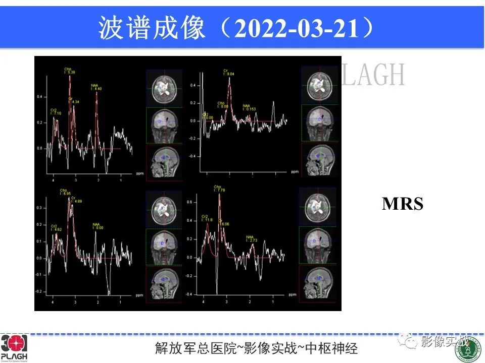 影像PPT - 【病例】中枢神经系统淋巴瘤1例CT及MR影像-17
