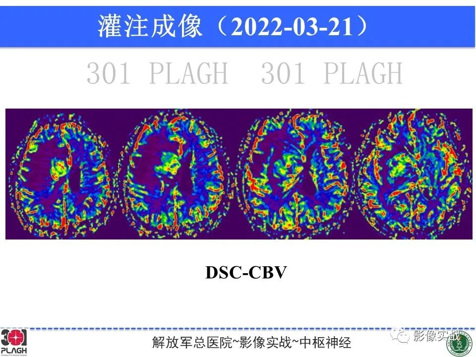 影像PPT - 【病例】中枢神经系统淋巴瘤1例CT及MR影像-16