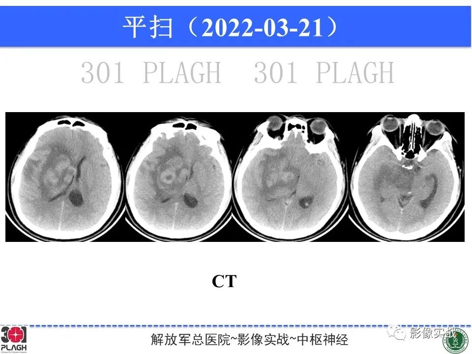 影像PPT - 【病例】中枢神经系统淋巴瘤1例CT及MR影像-18