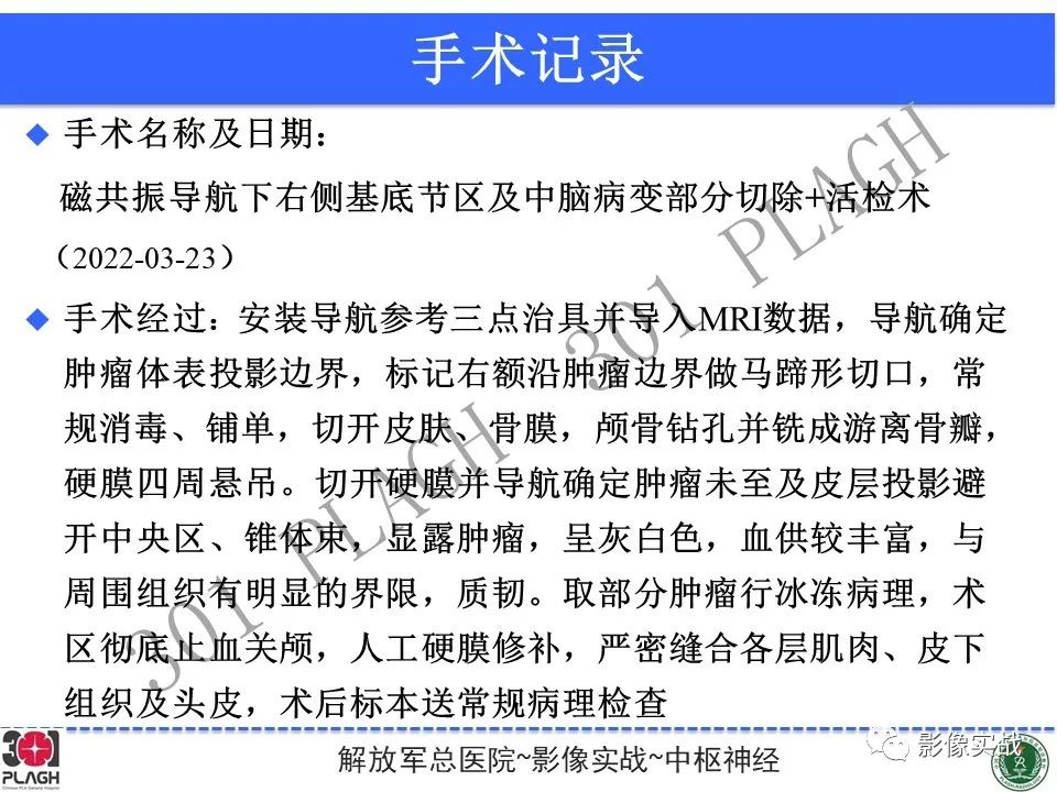 影像PPT - 【病例】中枢神经系统淋巴瘤1例CT及MR影像-27