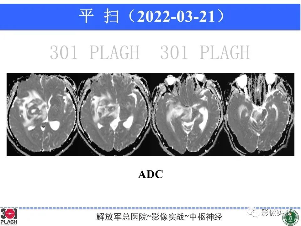 影像PPT - 【病例】中枢神经系统淋巴瘤1例CT及MR影像-8