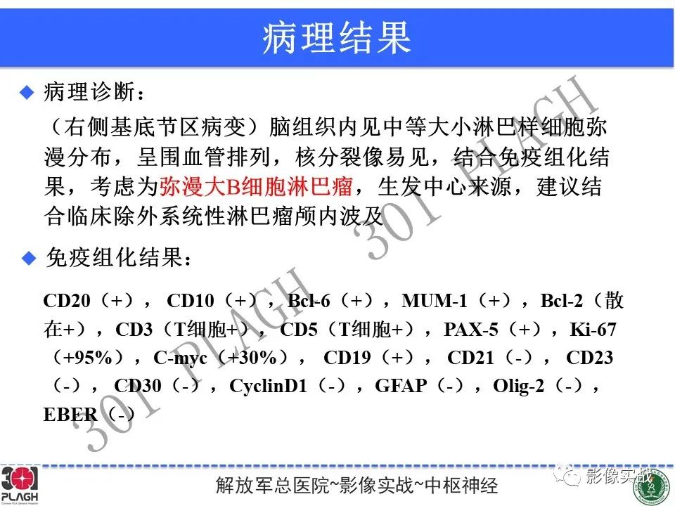 影像PPT - 【病例】中枢神经系统淋巴瘤1例CT及MR影像-28