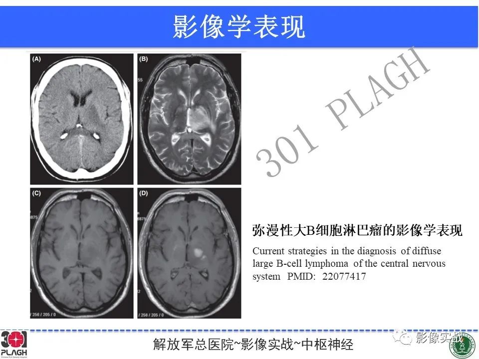 影像PPT - 【病例】中枢神经系统淋巴瘤1例CT及MR影像-32