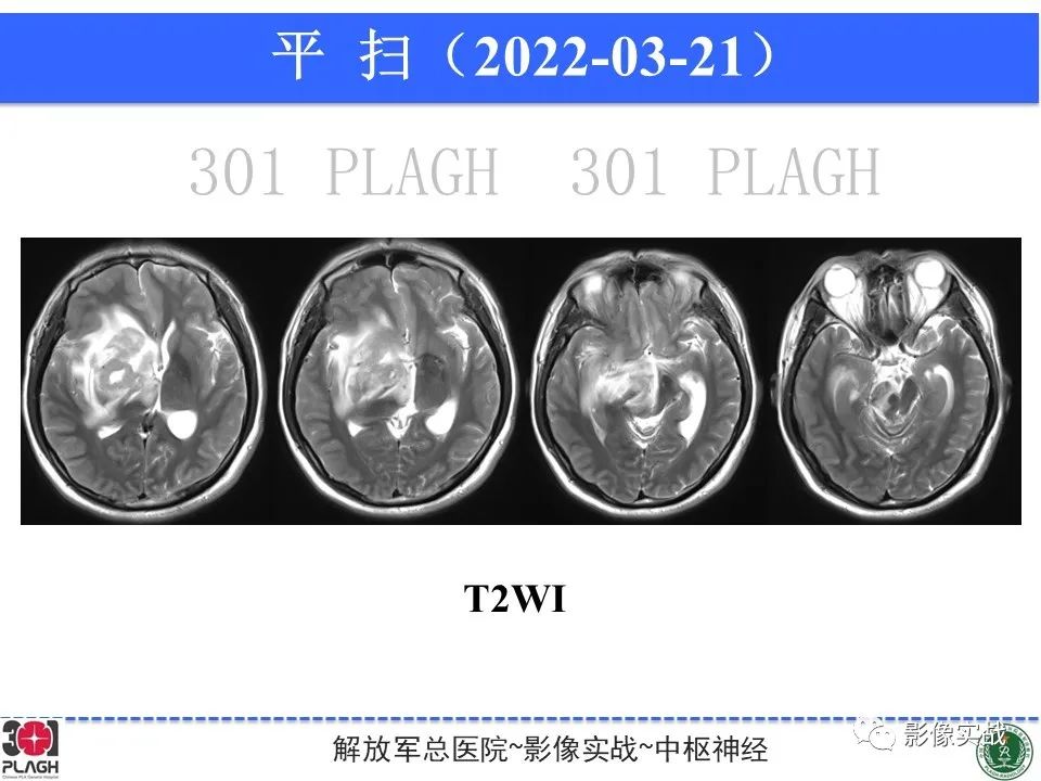 影像PPT - 【病例】中枢神经系统淋巴瘤1例CT及MR影像-2