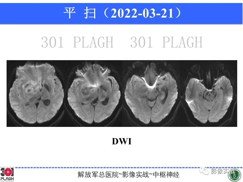 影像PPT - 【病例】中枢神经系统淋巴瘤1例CT及MR影像-3
