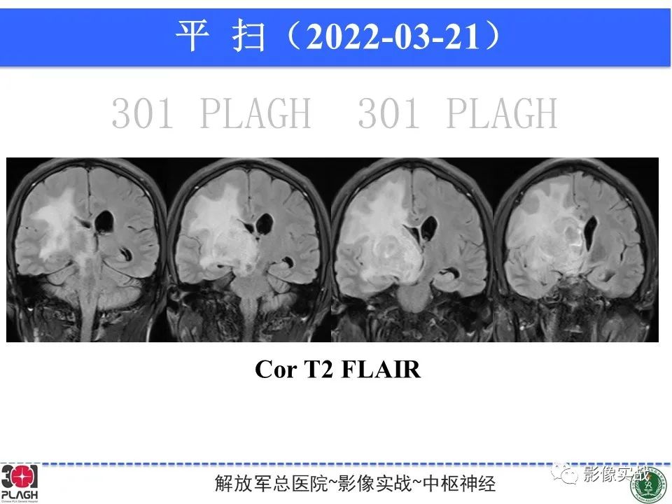 影像PPT - 【病例】中枢神经系统淋巴瘤1例CT及MR影像-4