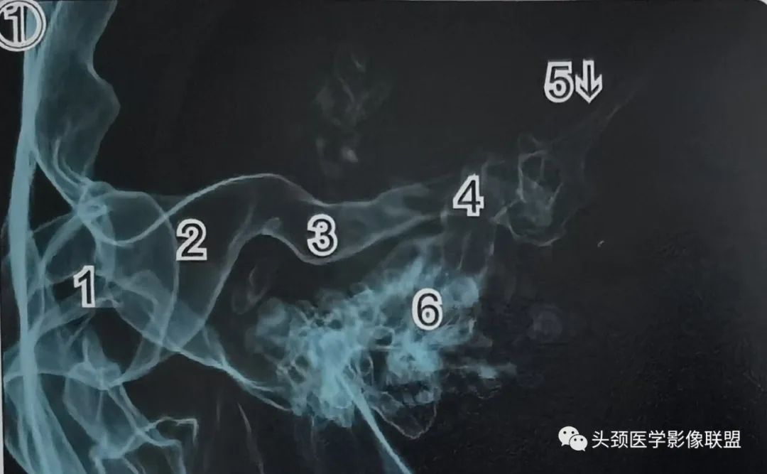 影像PPT - 外耳道及鼓膜解剖-2 影像PPT - 外耳道及鼓膜解剖-2