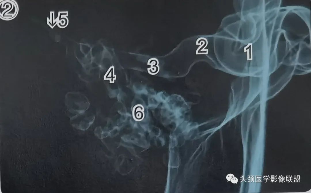 影像PPT - 外耳道及鼓膜解剖-3 影像PPT - 外耳道及鼓膜解剖-3