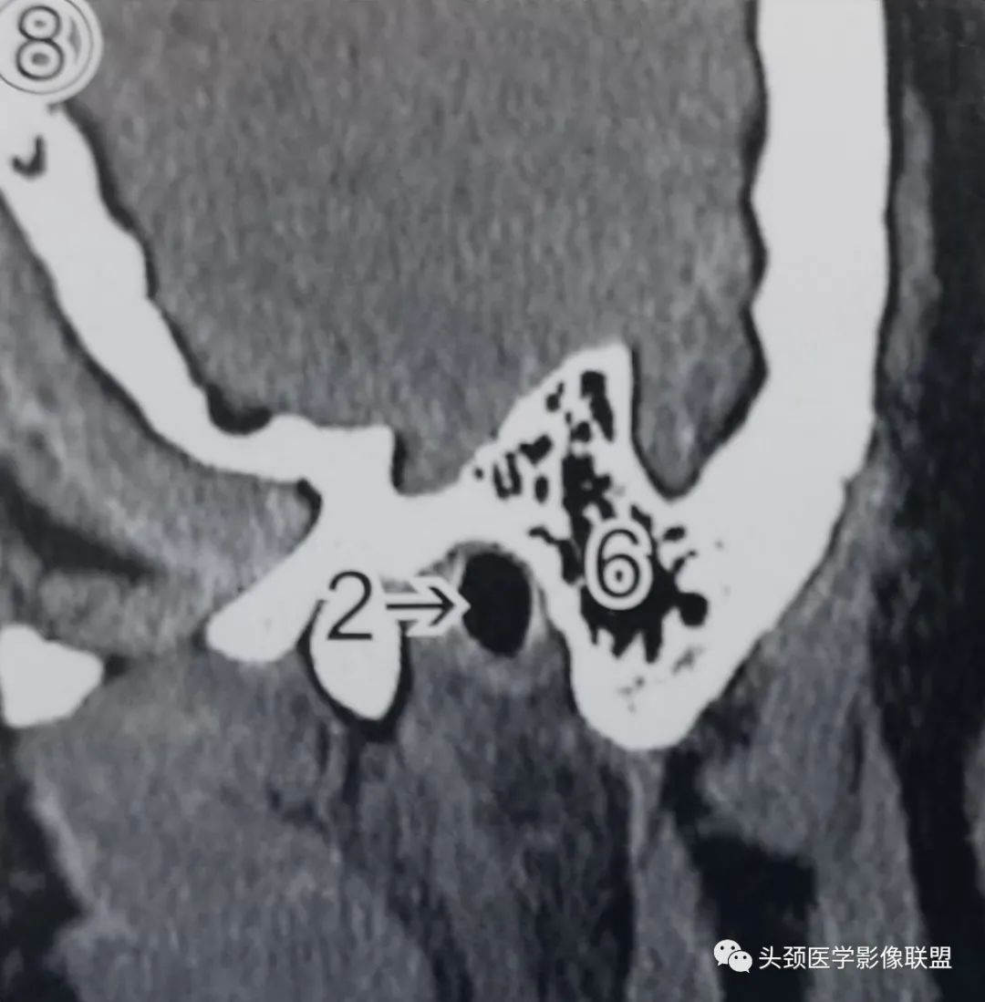 影像PPT - 外耳道及鼓膜解剖-9 影像PPT - 外耳道及鼓膜解剖-9