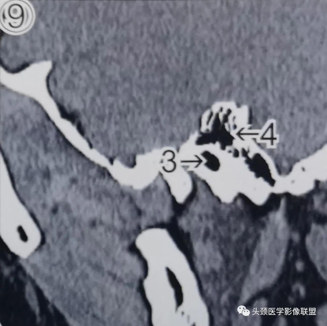 影像PPT - 外耳道及鼓膜解剖-10 影像PPT - 外耳道及鼓膜解剖-10