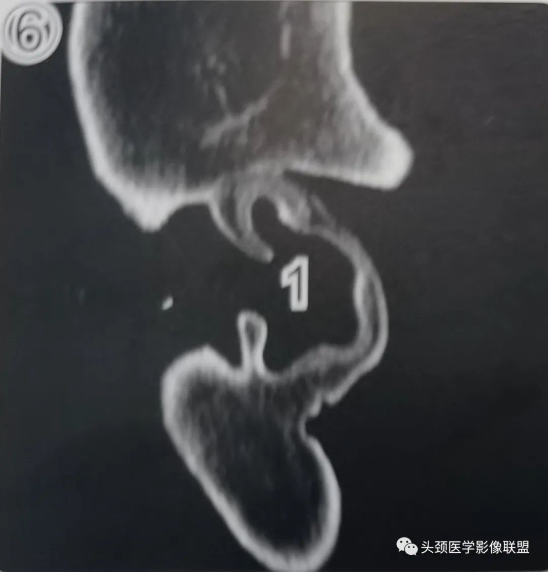影像PPT - 外耳道及鼓膜解剖-2 影像PPT - 外耳道及鼓膜解剖-2