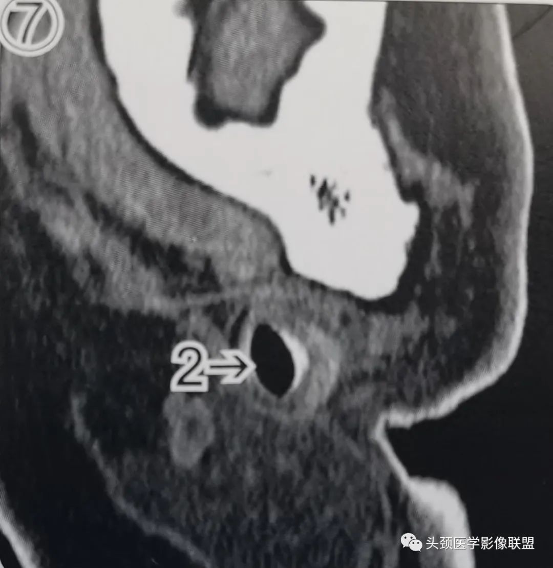 影像PPT - 外耳道及鼓膜解剖-3 影像PPT - 外耳道及鼓膜解剖-3