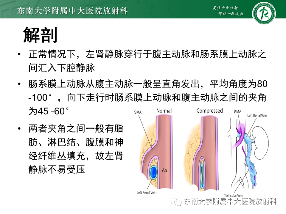 影像PPT - 【PPT】胡桃夹综合征-5