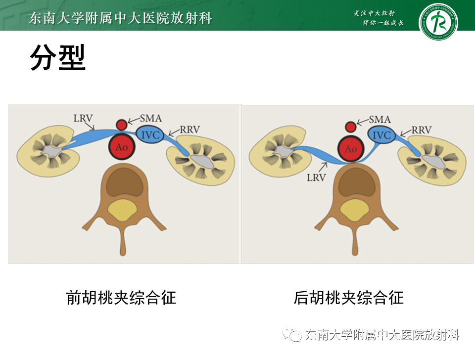 影像PPT - 【PPT】胡桃夹综合征-7