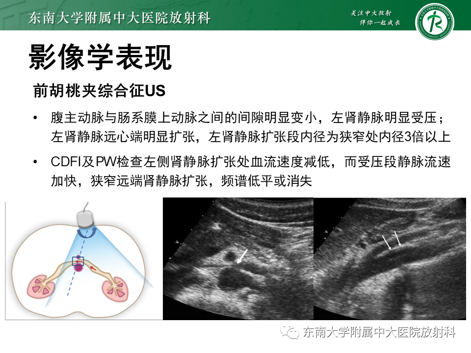 影像PPT - 【PPT】胡桃夹综合征-12