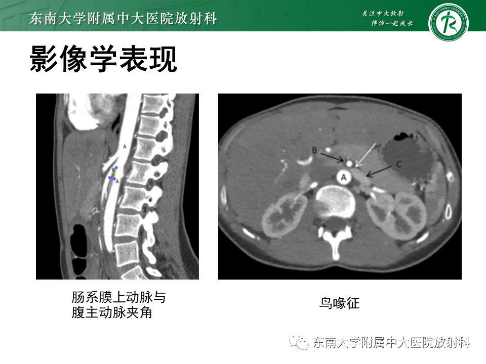 影像PPT - 【PPT】胡桃夹综合征-11