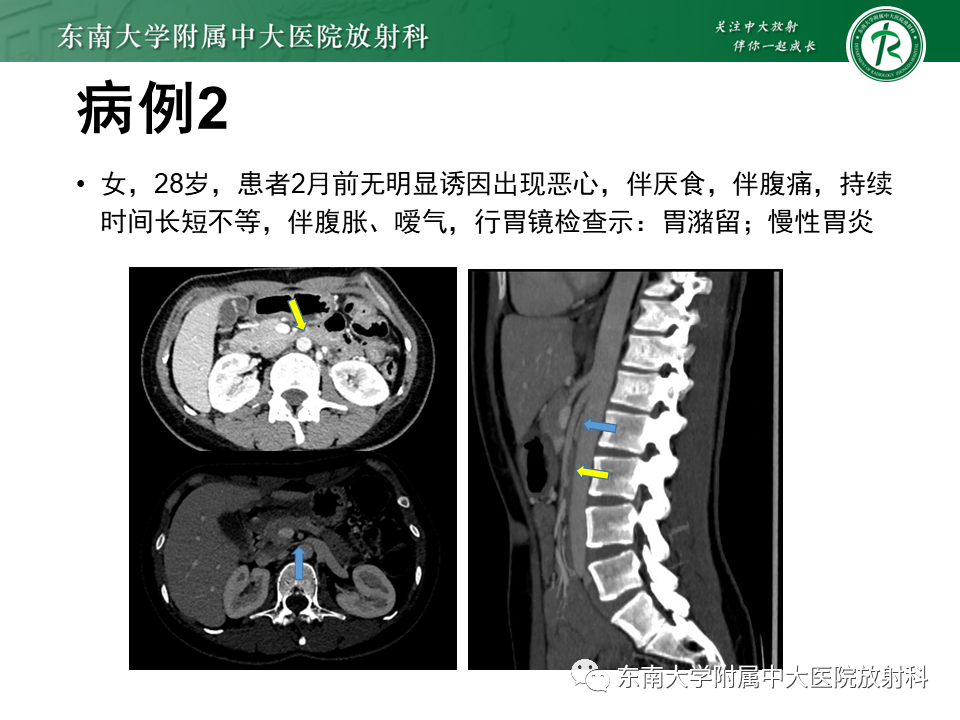 影像PPT - 【PPT】胡桃夹综合征-16
