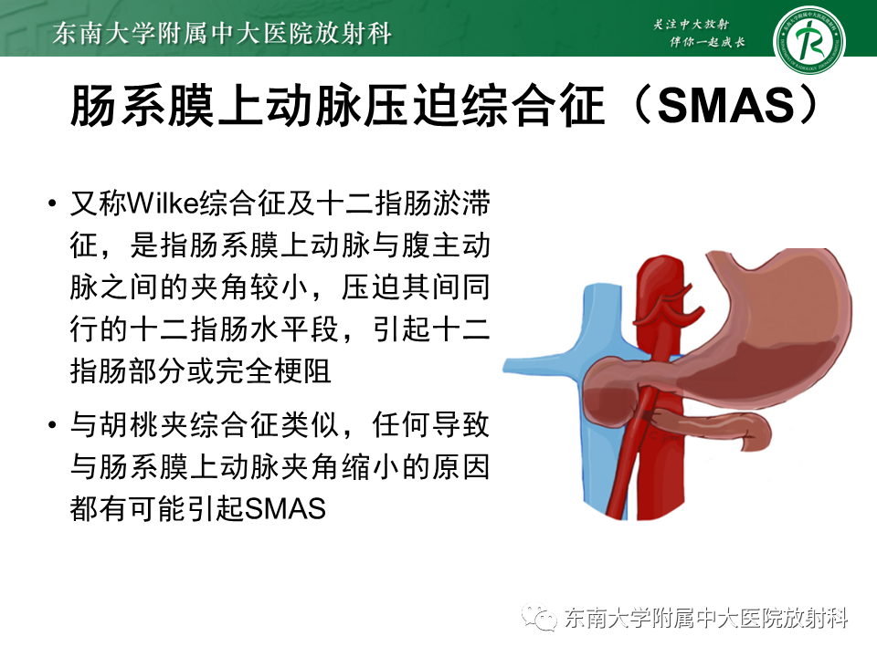 影像PPT - 【PPT】胡桃夹综合征-18
