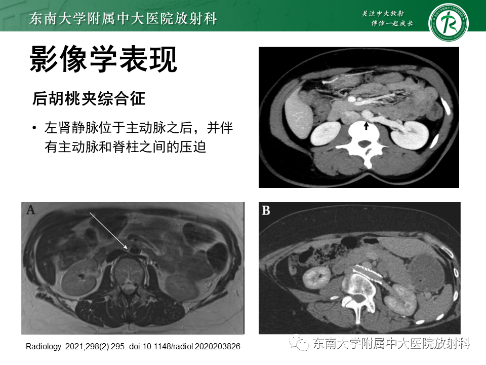影像PPT - 【PPT】胡桃夹综合征-13