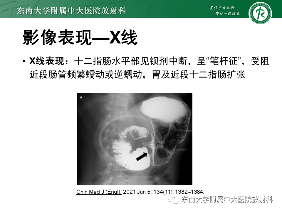 影像PPT - 【PPT】胡桃夹综合征-20