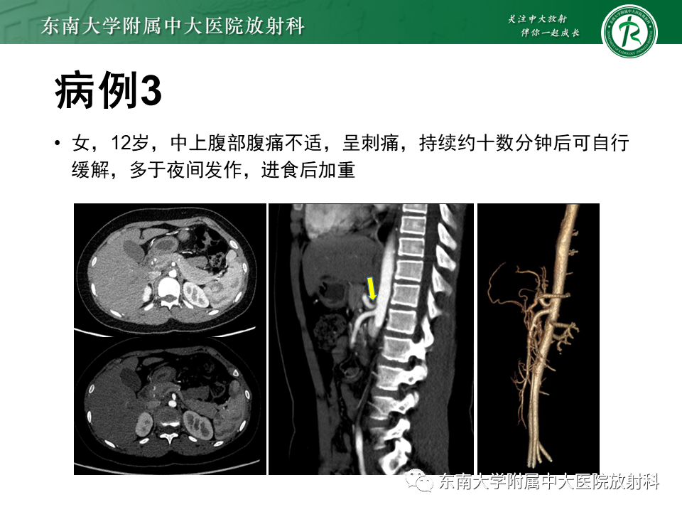 影像PPT - 【PPT】胡桃夹综合征-23