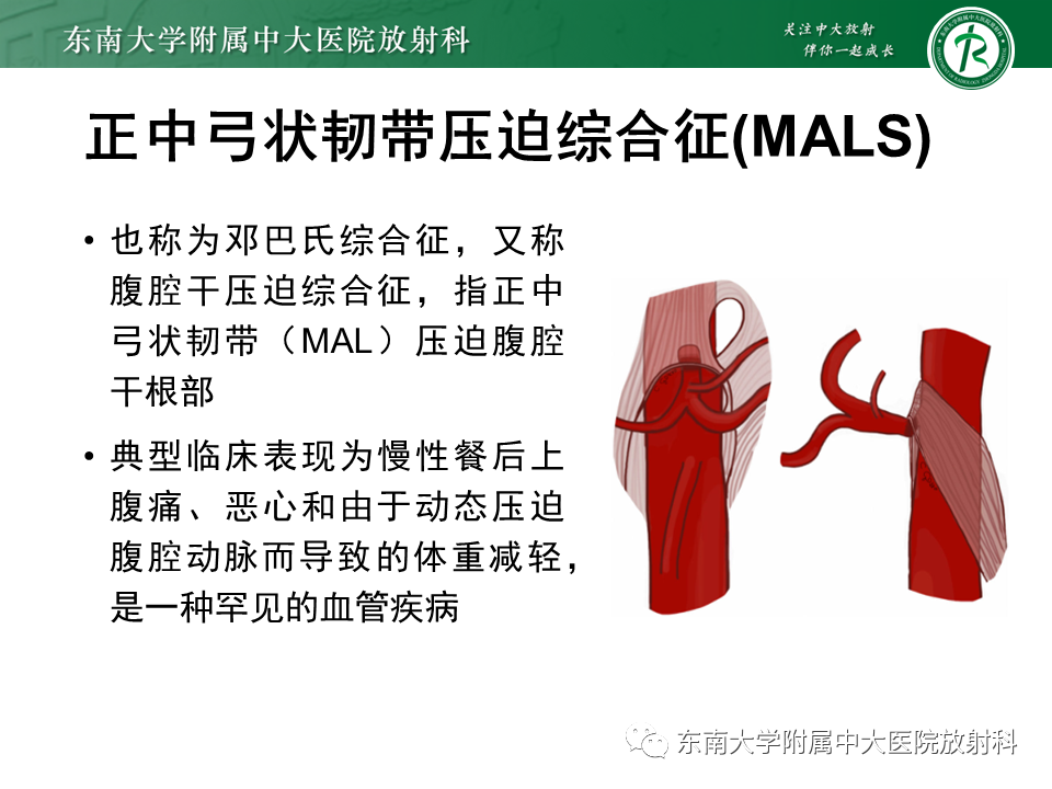 影像PPT - 【PPT】胡桃夹综合征-25