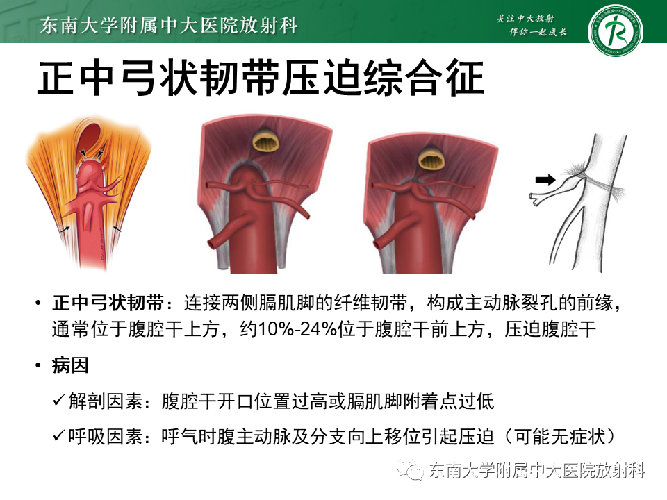 影像PPT - 【PPT】胡桃夹综合征-26