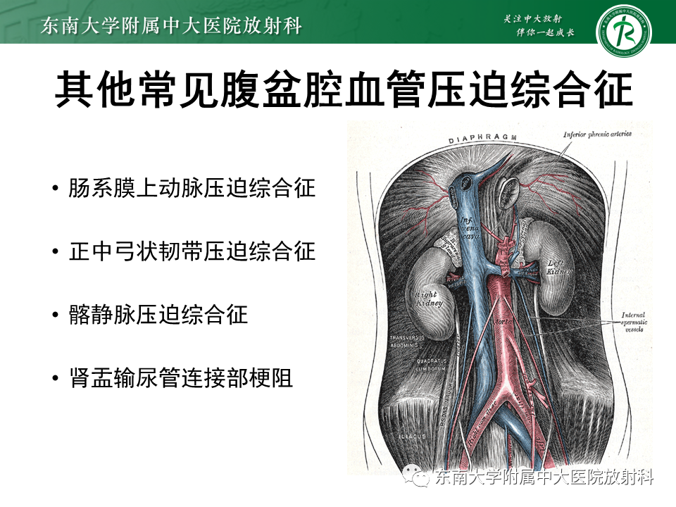 影像PPT - 【PPT】胡桃夹综合征-15