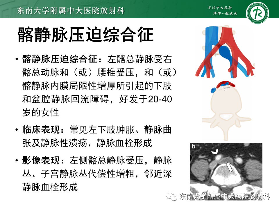 影像PPT - 【PPT】胡桃夹综合征-29