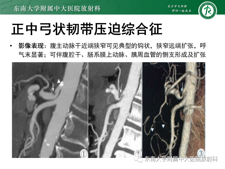 影像PPT - 【PPT】胡桃夹综合征-27