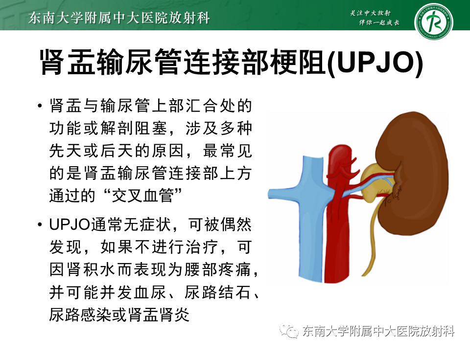 影像PPT - 【PPT】胡桃夹综合征-30