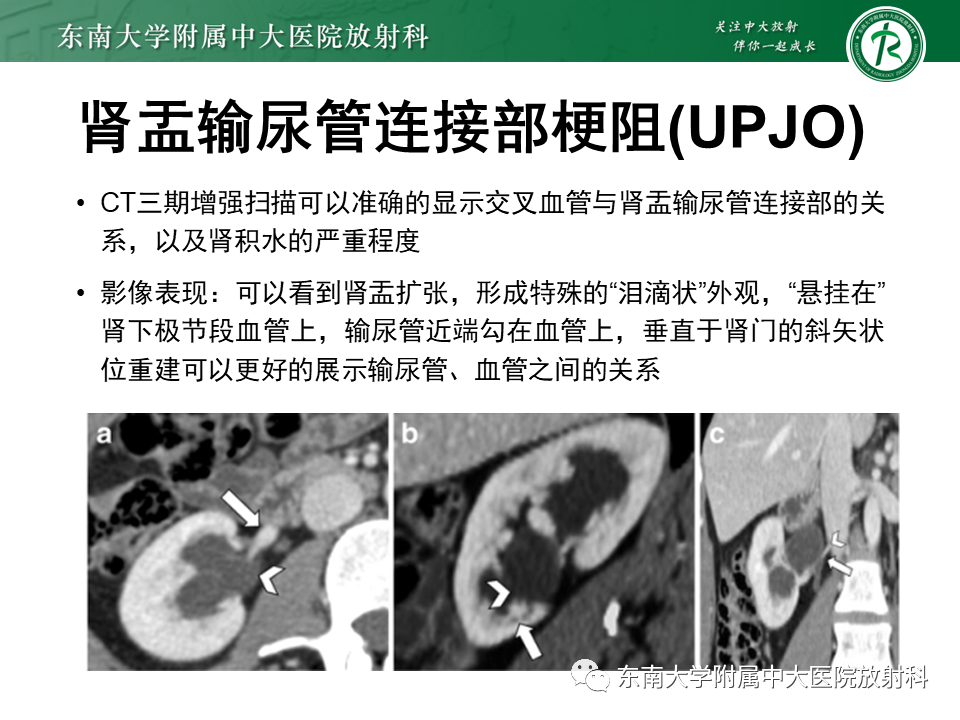 影像PPT - 【PPT】胡桃夹综合征-31