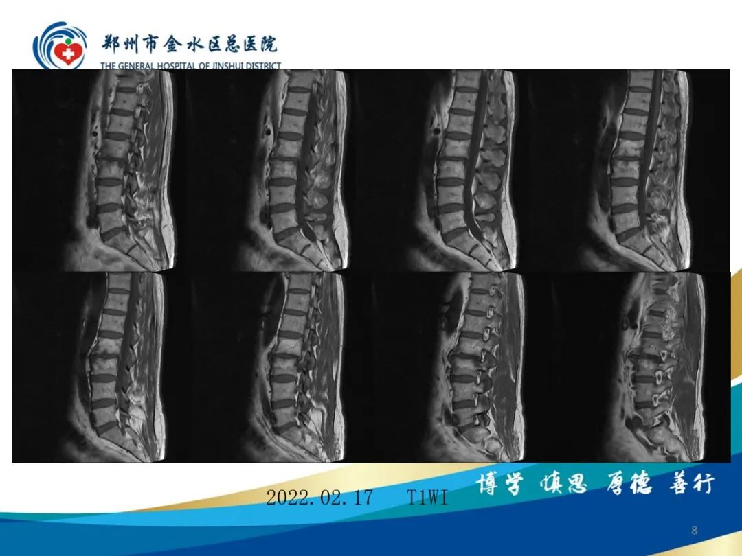 影像PPT - 【PPT】布鲁氏杆菌脊柱炎-8