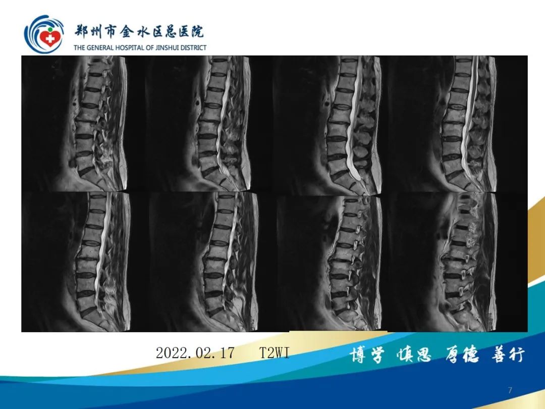 影像PPT - 【PPT】布鲁氏杆菌脊柱炎-7