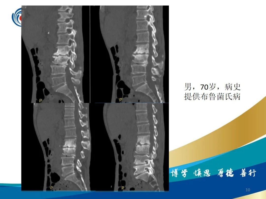 影像PPT - 【PPT】布鲁氏杆菌脊柱炎-10
